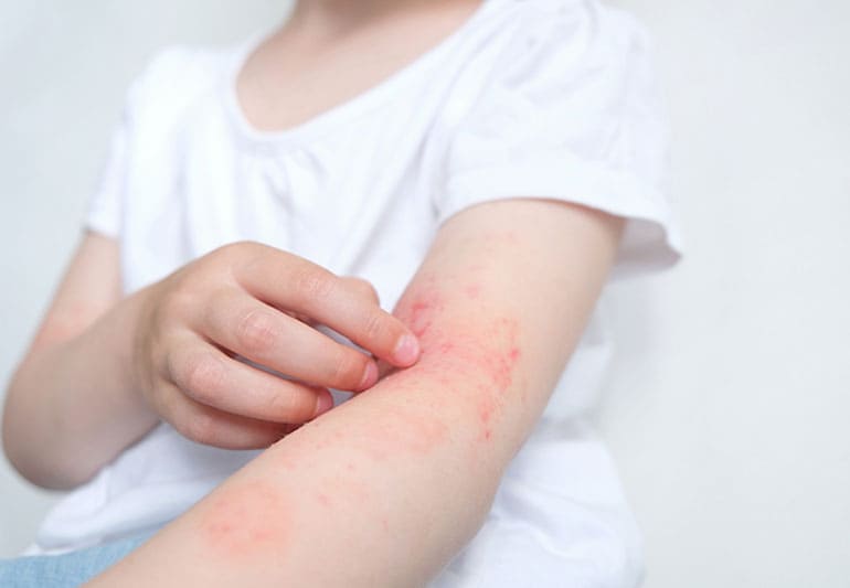 アトピー性皮膚炎とは